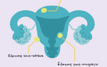 Mon Fibrome
